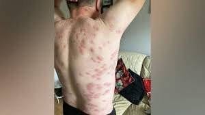Multiple Wasp Stings