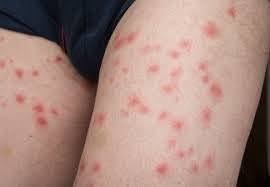 infection after an insect bite vs allergy