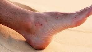 sand flea bites contagious in kids